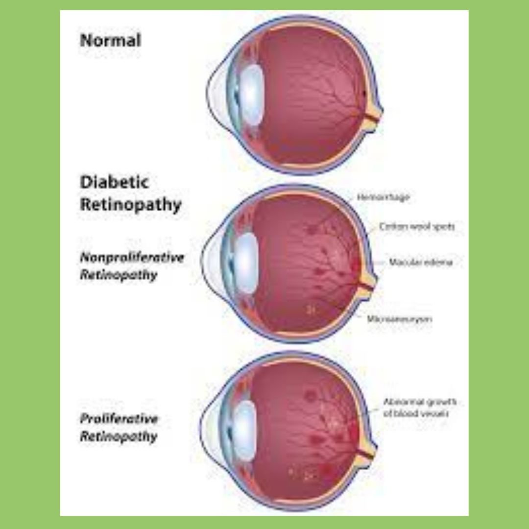 Diabetic Retinopathy - The Diabetes Kitchen