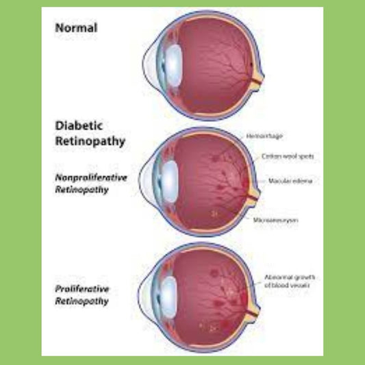 Diabetic Retinopathy - The Diabetes Kitchen